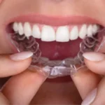 How Invisalign Works to Straighten Teeth Discreetly