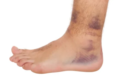 Different Types of Ankle Sprains and Their Treatments