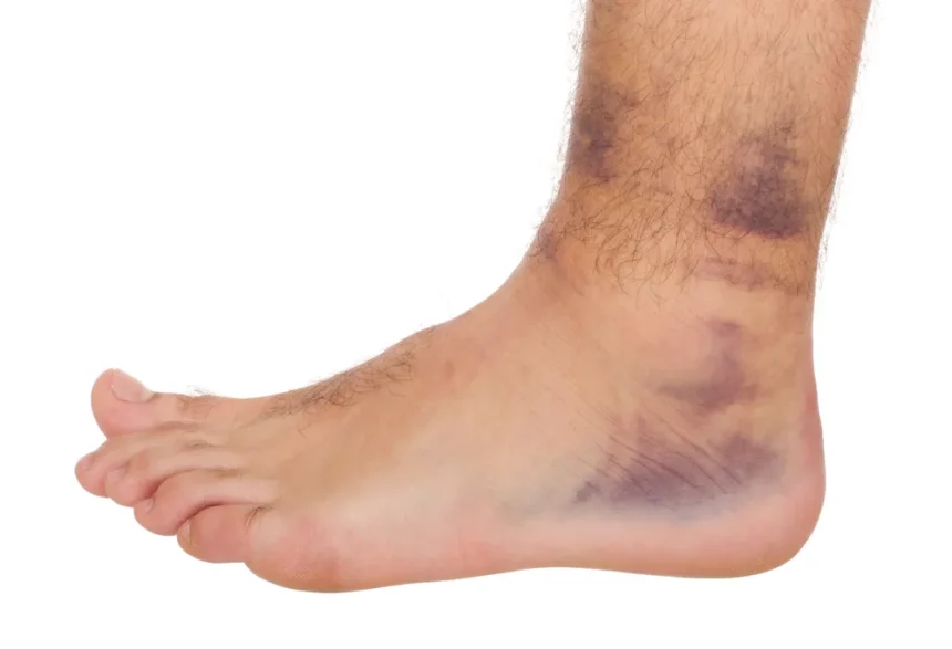 Different Types of Ankle Sprains and Their Treatments