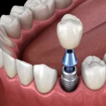 Smart Dental Implants The Next Step in Digital Dentistry